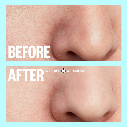 PEACE OUT Skincare Pore Minimizing Strips,